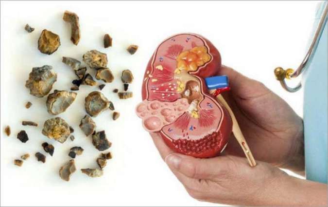 obat ginjal batu, batu ginjal
